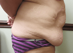 Abdominoplasty Before and After Pictures West Palm Beach, FL