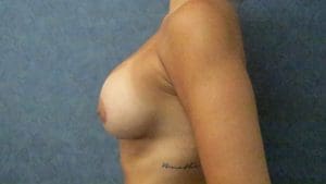 Breast Augmentation Before and After Pictures West Palm Beach, FL