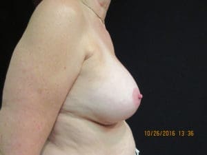 Breast Augmentation Before and After Pictures West Palm Beach, FL